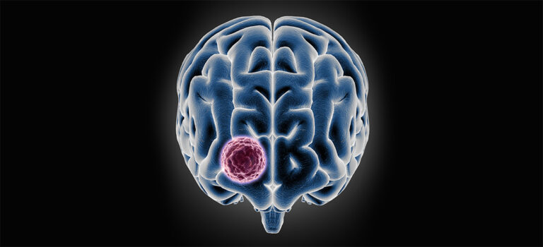 Representação de tumores cerebrais